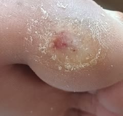 زخم دیابتی بوده که با چند جلسه کار درست شده