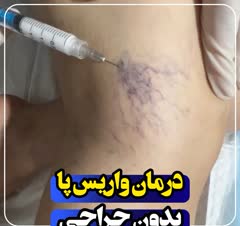 درمان واریس بدون جراحی