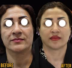 فول فیس فیلر