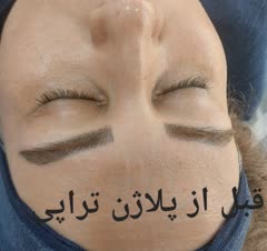 پلاژن تراپی